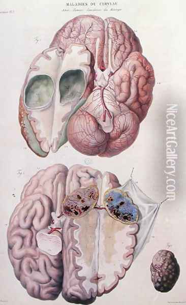 Cancerous tumours of the brain, from 'Anatomie Pathologique du Corps Humain' Oil Painting - Antoine Chazal